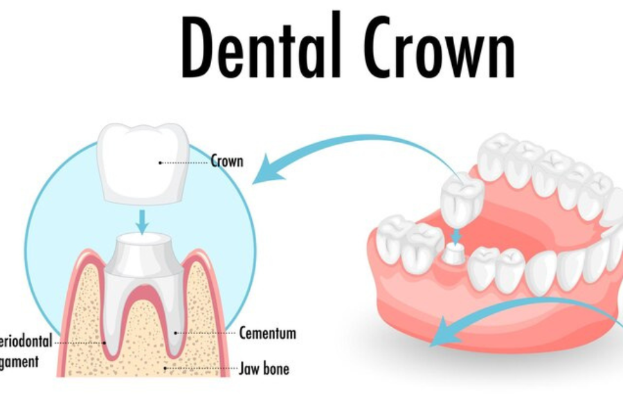 dental crowns