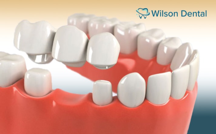 dental crowns and bridges