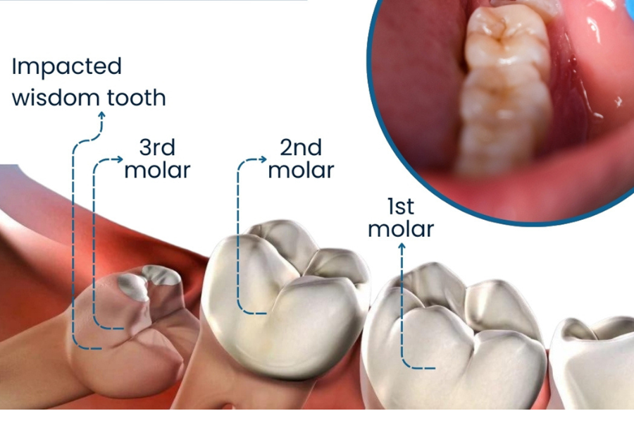 Wisdom Teeth Extractions