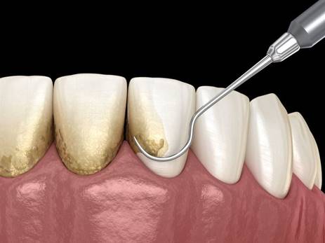 Teeth Whitening Services